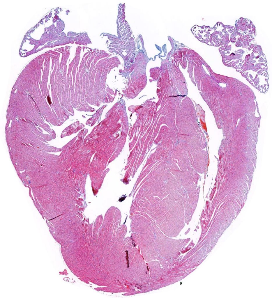 Cardiac hypertrophy under the microscope.